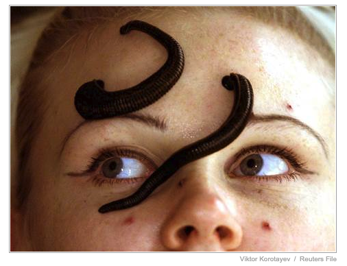 woman receiving leech treatment