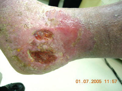crusty ulcers on foot